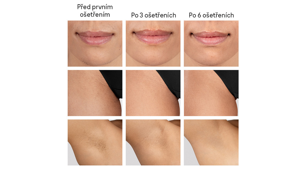 Srovnání výsledků po použití IPL Braun IPL5351 Silk·expert