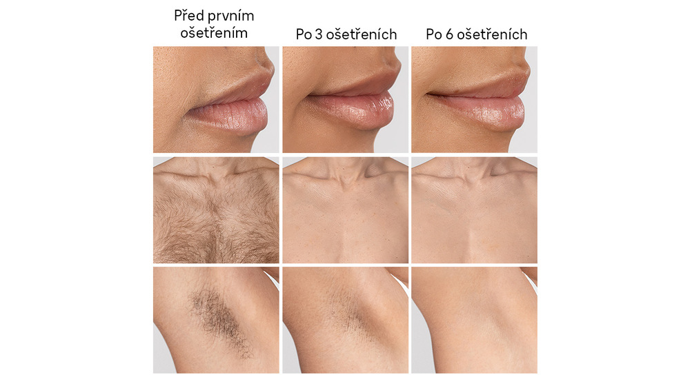 Srovnání výsledků po použití IPL Braun IPL7431 Skin i·expert