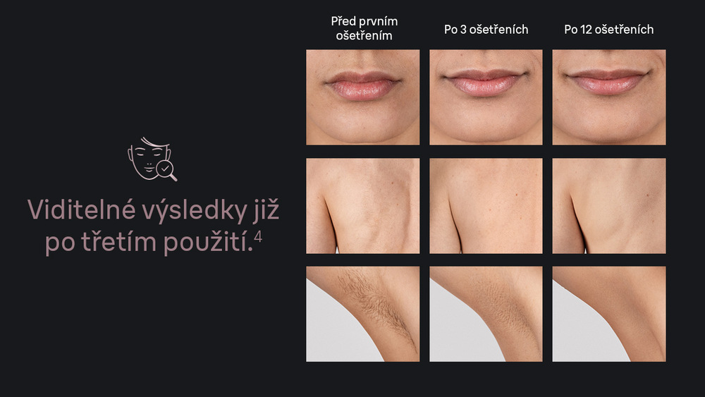Srovnání výsledků po použití IPL Braun IPL1111 Silk·expert Mini