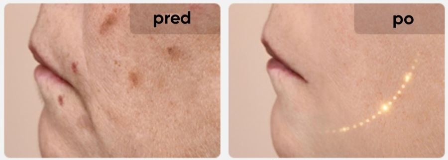 Srovnání pleti před a po použití masky JOVS JM2C